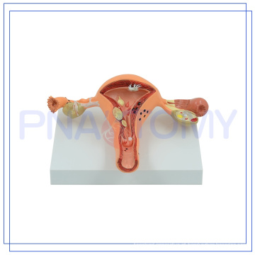 PNT-0742 Modelo profissional do útero humano para hospital